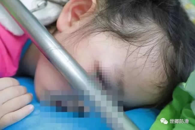 5歲女童滑倒，鉤子鉤入眼睛：孩子平安長大有多難？